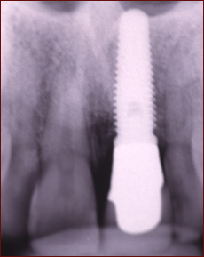Final Xray After Implant copy