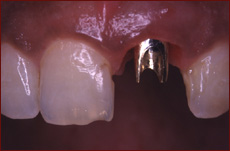 Implant Replacing Missing Tooth copy