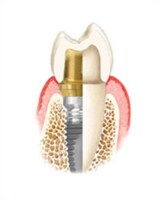 implant 1