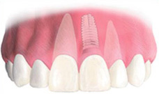 implant 2